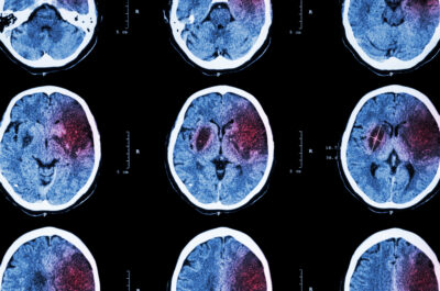 Ischemic stroke : ( CT of brain show cerebral infarction at left frontal – temporal – parietal lobe ) ( nervous system background )