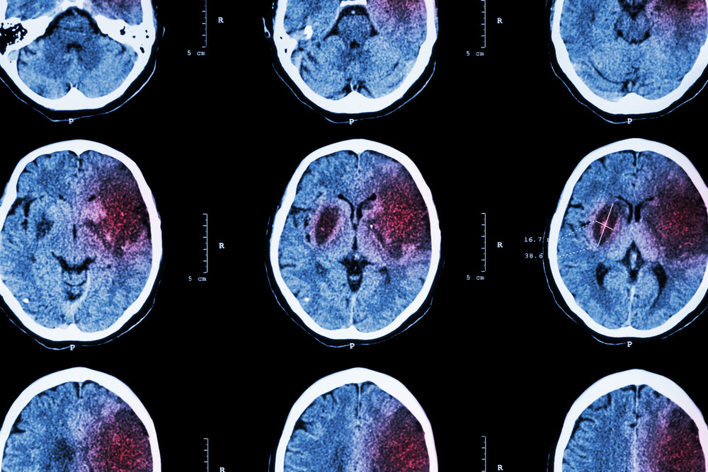 Cómo prevenir un accidente cerebrovascular: 5 consejos prácticos a seguir